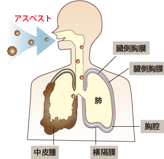 aアスベストが人体にもたらす影響